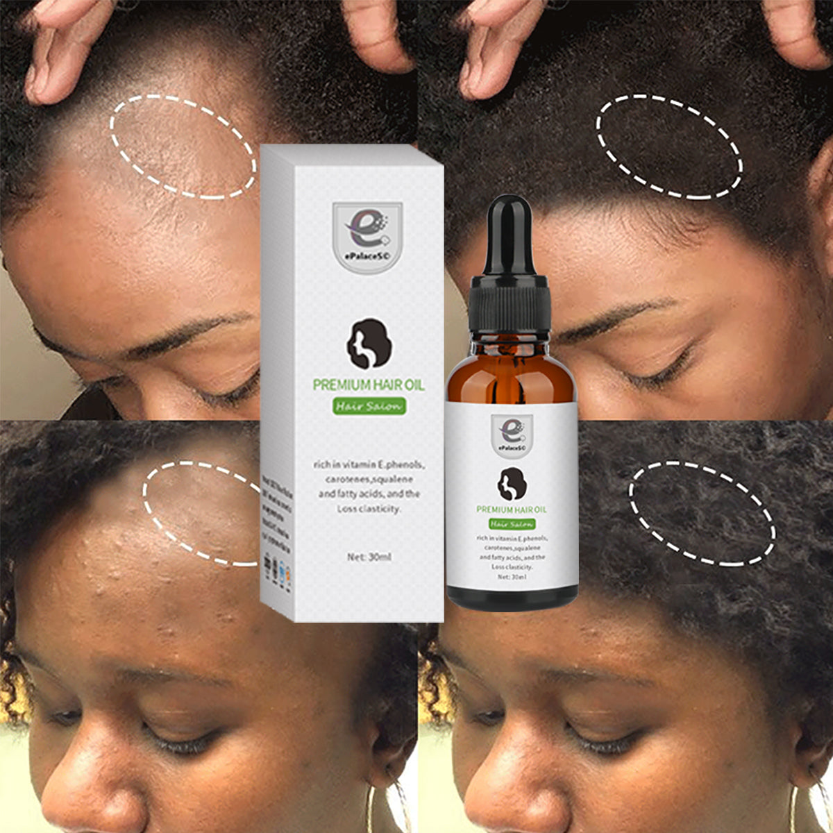 hair regrowth oil